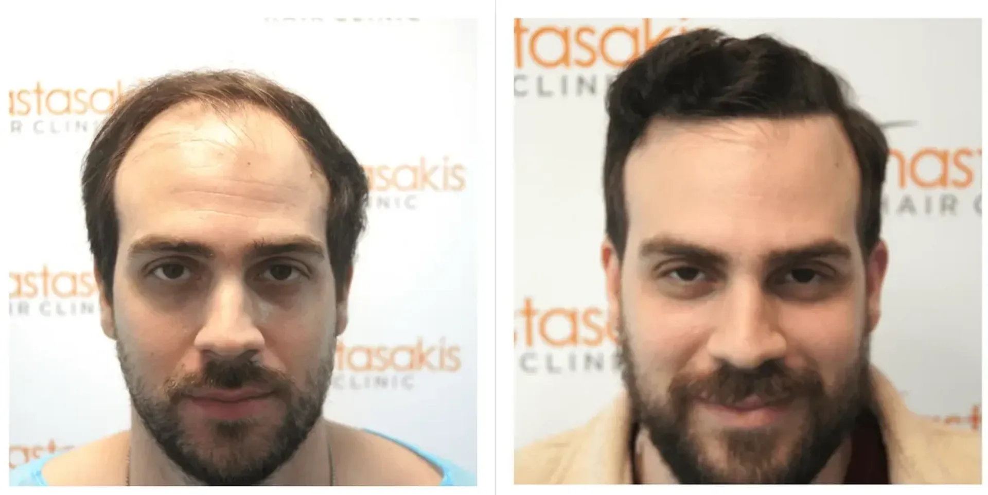 Before/After - Frontal area - FUE motorized results