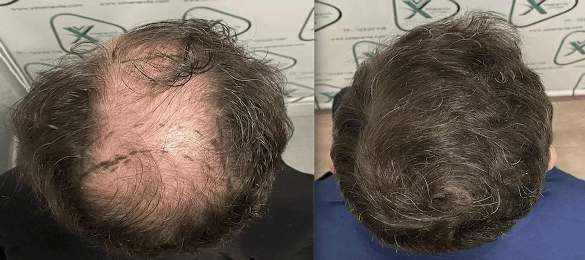 Before/After - Extensive Hair Loss - FUE manual & Direct FUE (DHI) results