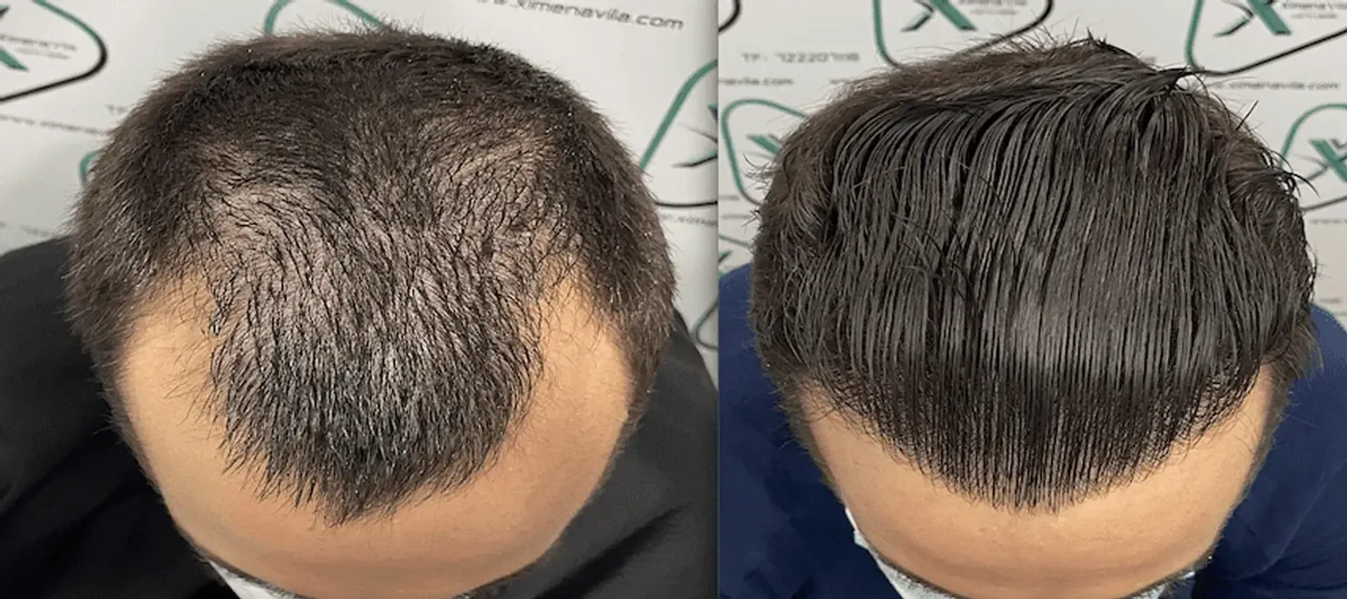 Before/After - Frontal area - FUE manual & Direct FUE (DHI) results