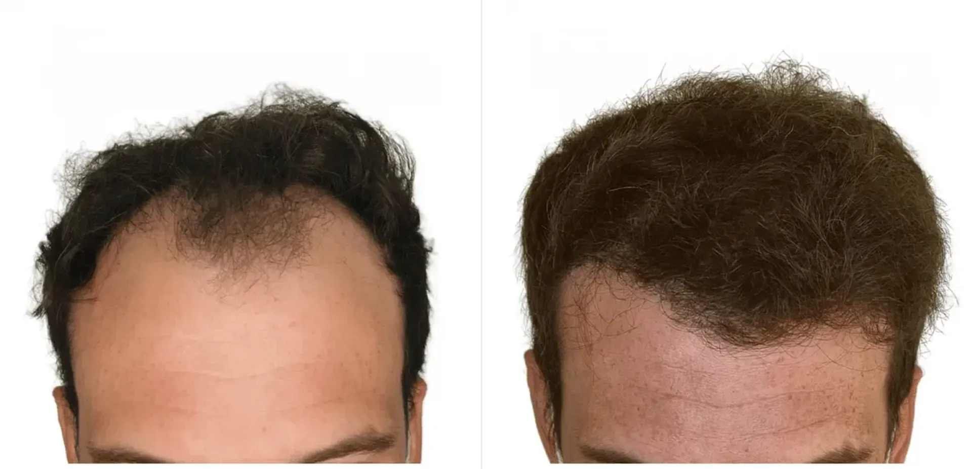 Before/After - Frontal area - FUE motorized & Direct FUE (DHI) results