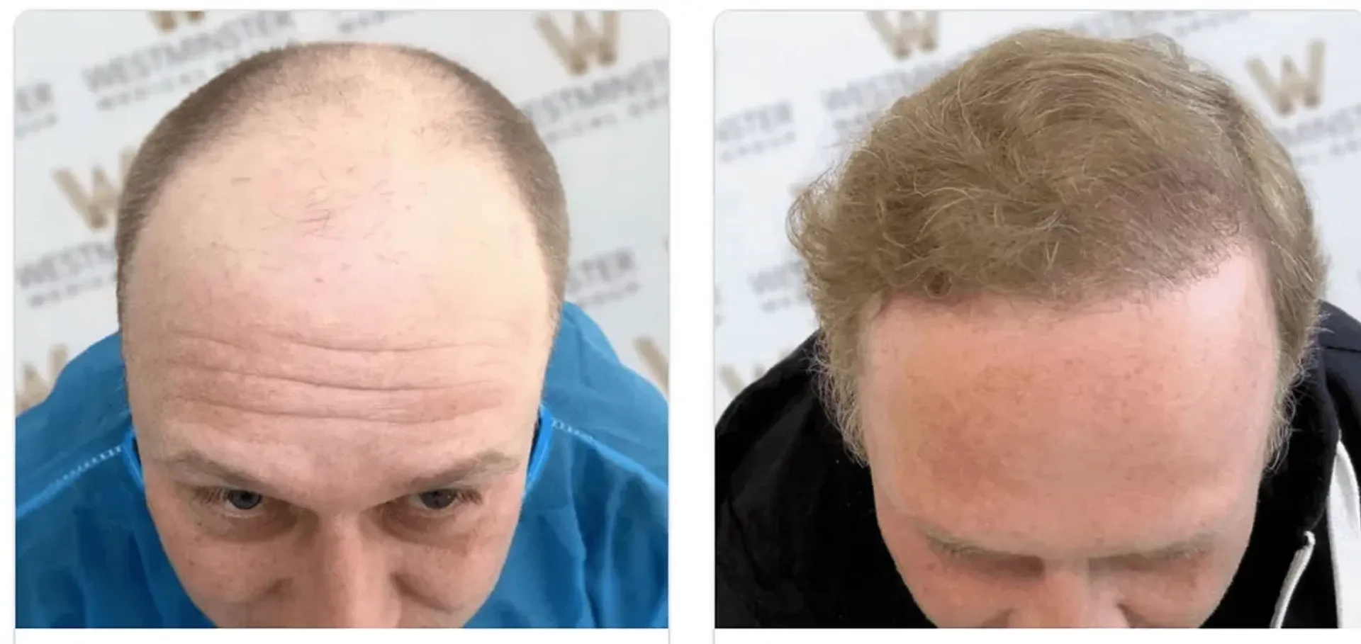 Before/After - Extensive Hair Loss - FUT & FUE motorized results