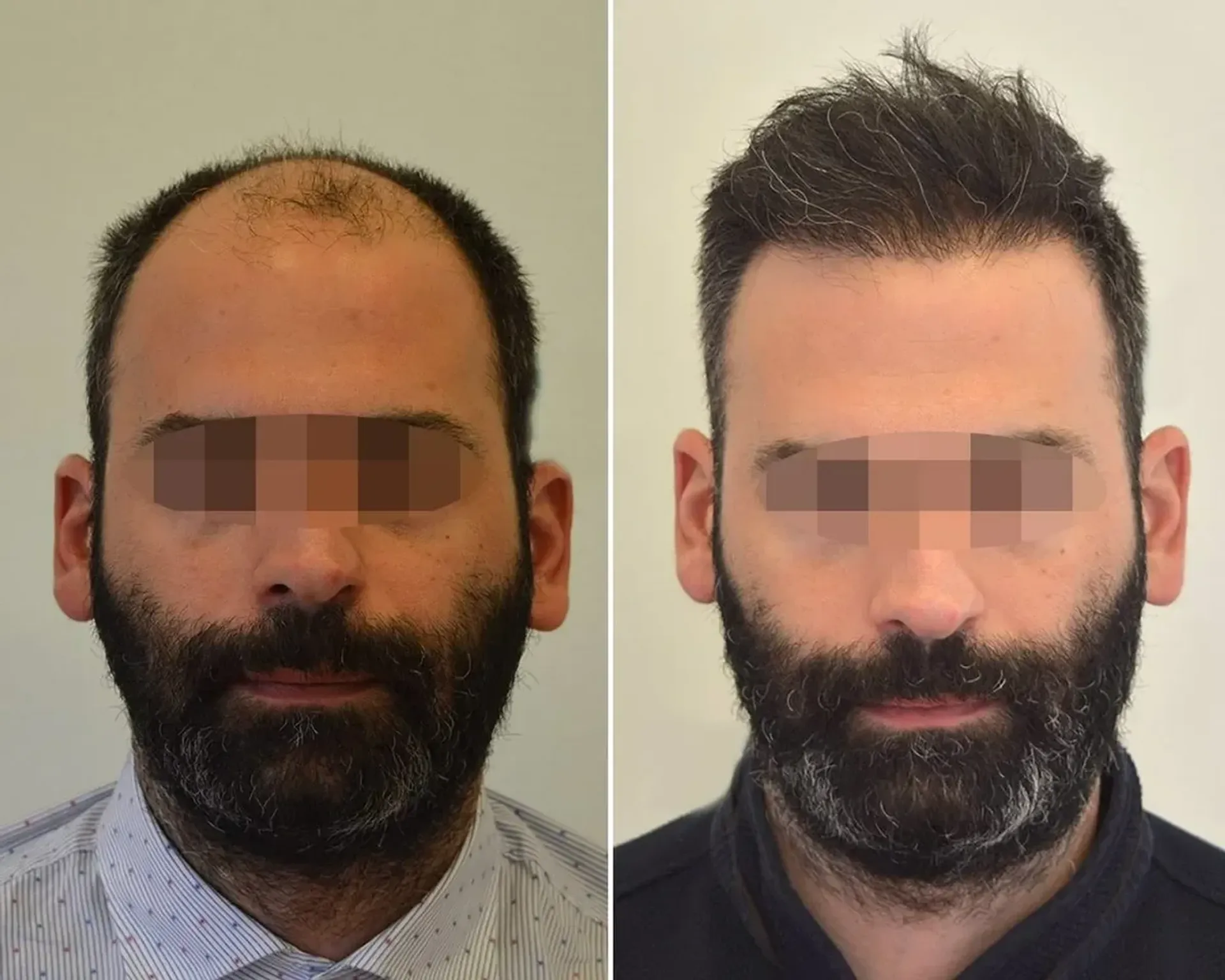 Before/After - Extensive Hair Loss & Frontal area - FUE motorized & Direct FUE (DHI) results