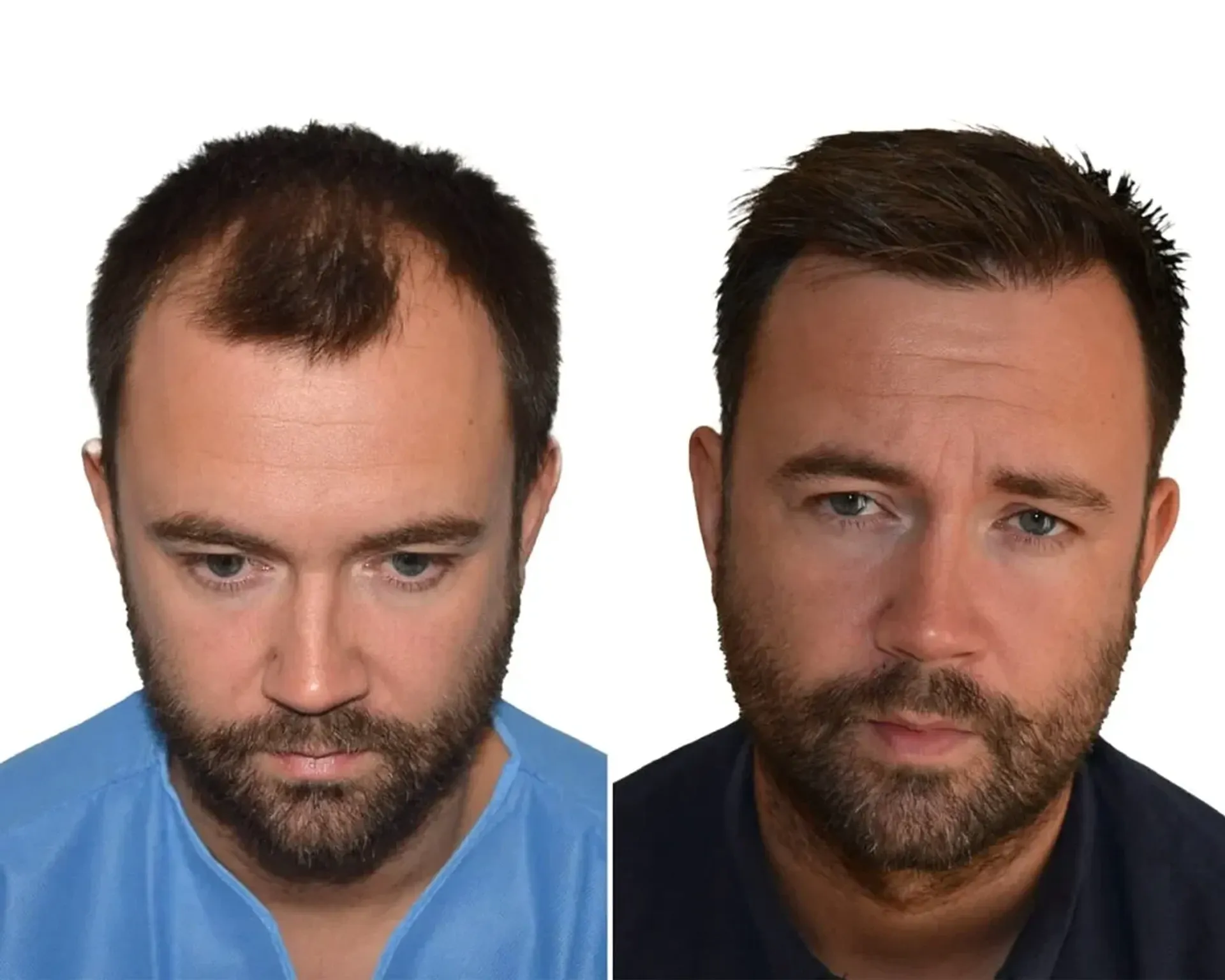 Before/After - Frontal area - FUE motorized & Direct FUE (DHI) results