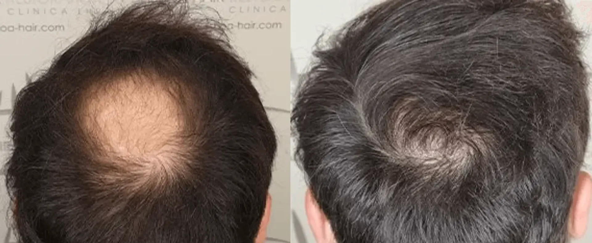 Before/After - Crown / Vertex - FUE motorized & Direct FUE (DHI) results