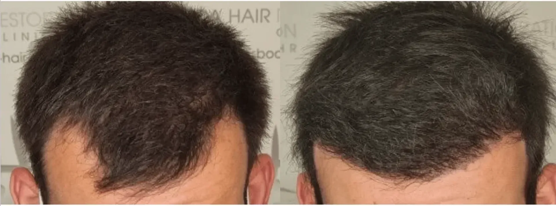 Before/After - Frontal area - FUE motorized & Direct FUE (DHI) results