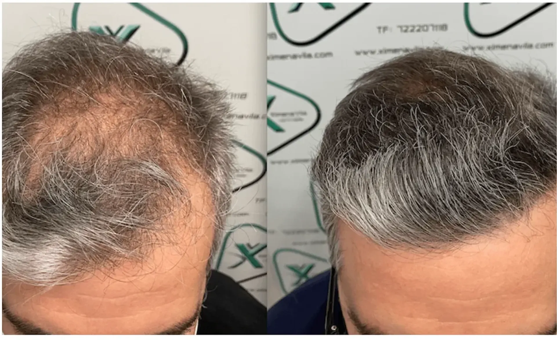 Before/After - Frontal area - FUE manual & Direct FUE (DHI) results