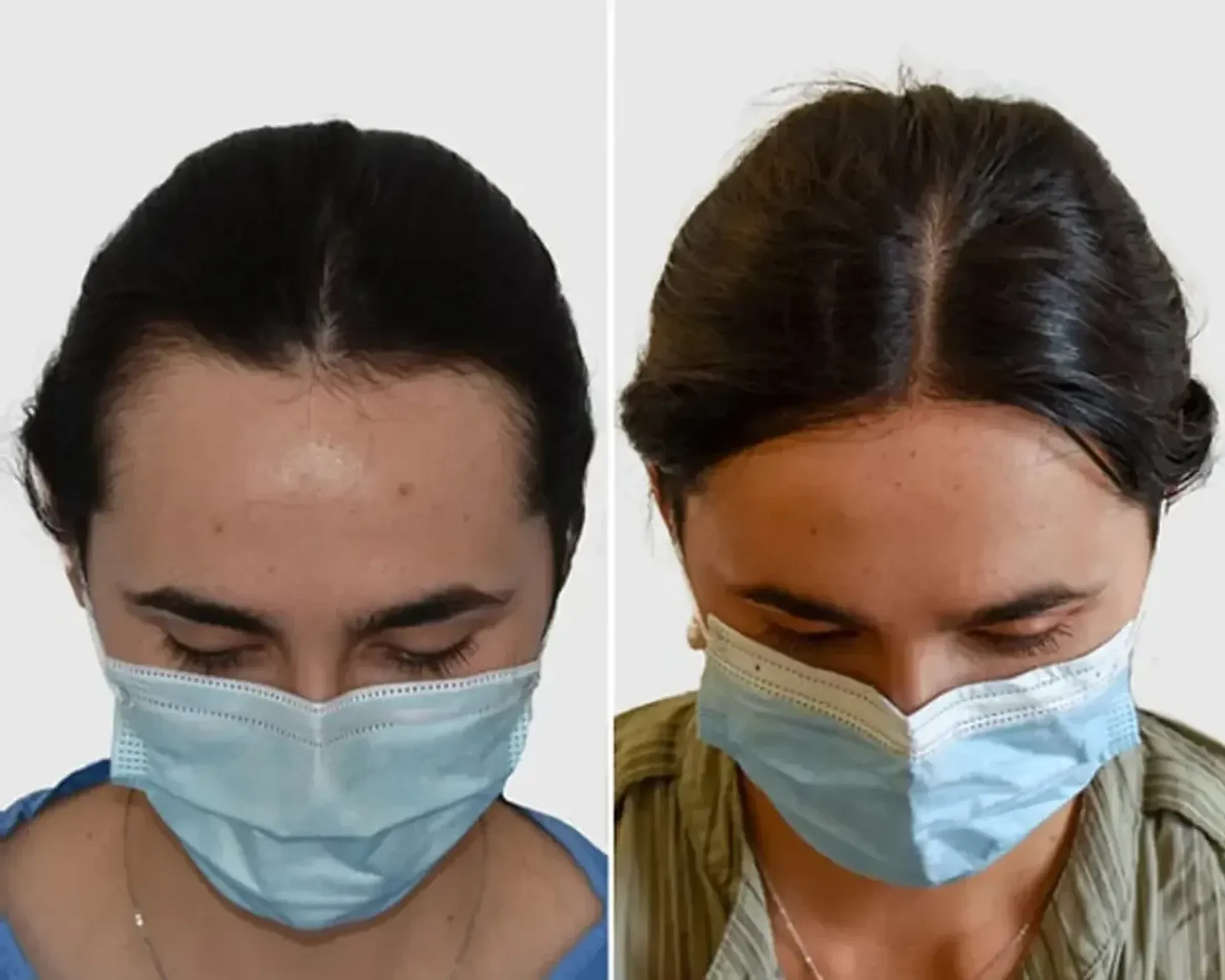 Before/After - Frontal area - FUE motorized & Direct FUE (DHI) results