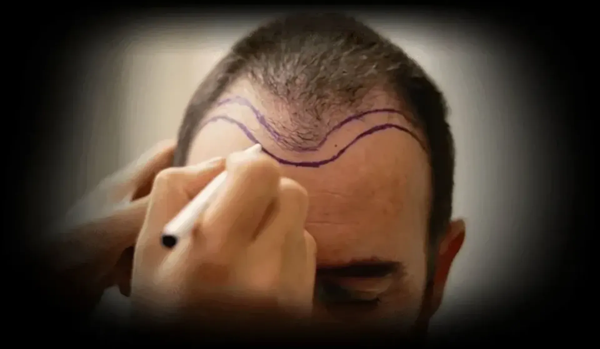 Dr Guncel Ozturk, HairNeva, Istanbul, Turkey - Istanbul, Turkey