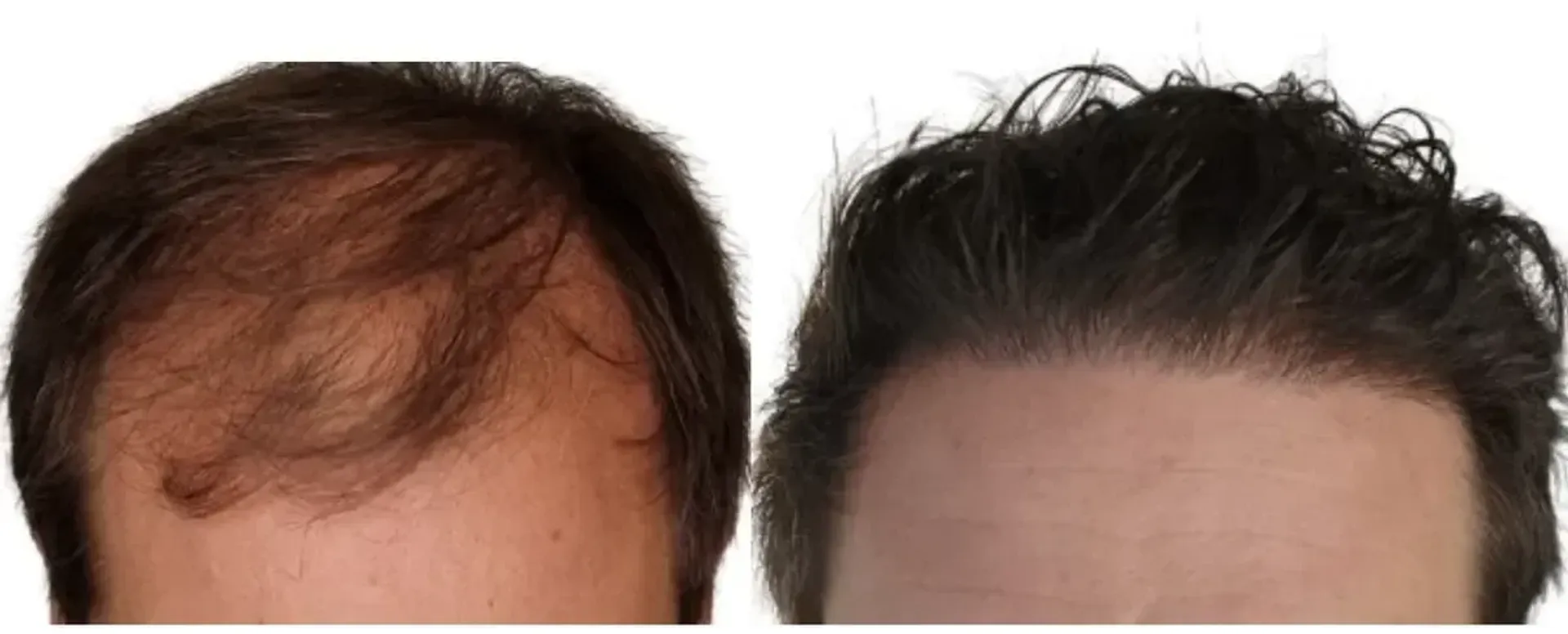 Before/After - Frontal area - FUE motorized & Direct FUE (DHI) results