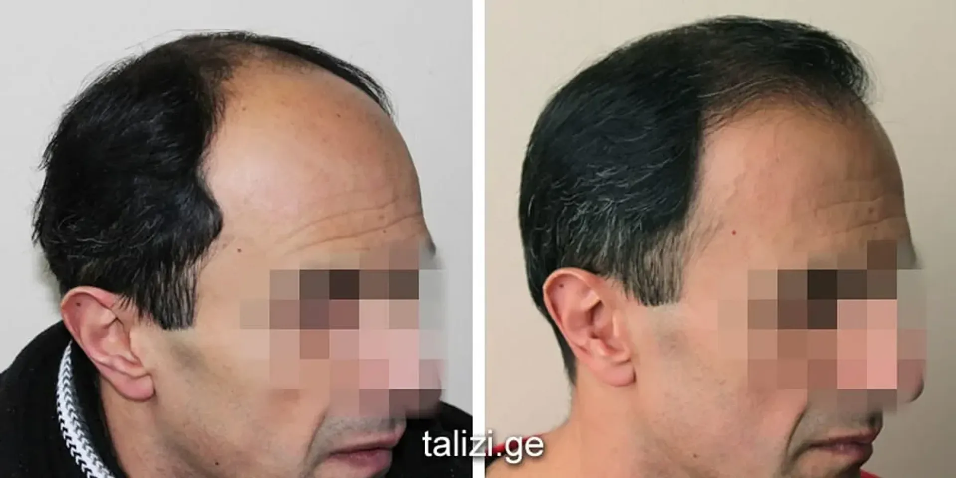 Before/After - Frontal area - FUE motorized results