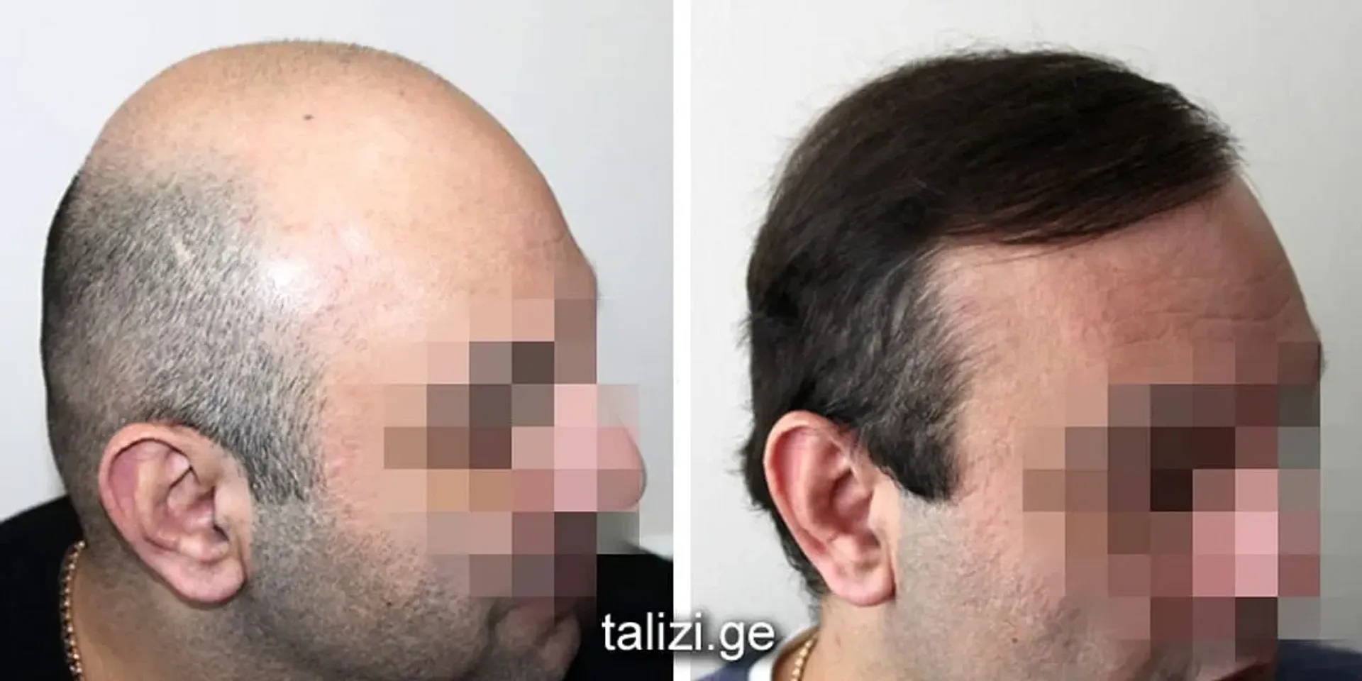 Before/After - Extensive Hair Loss - FUE motorized results