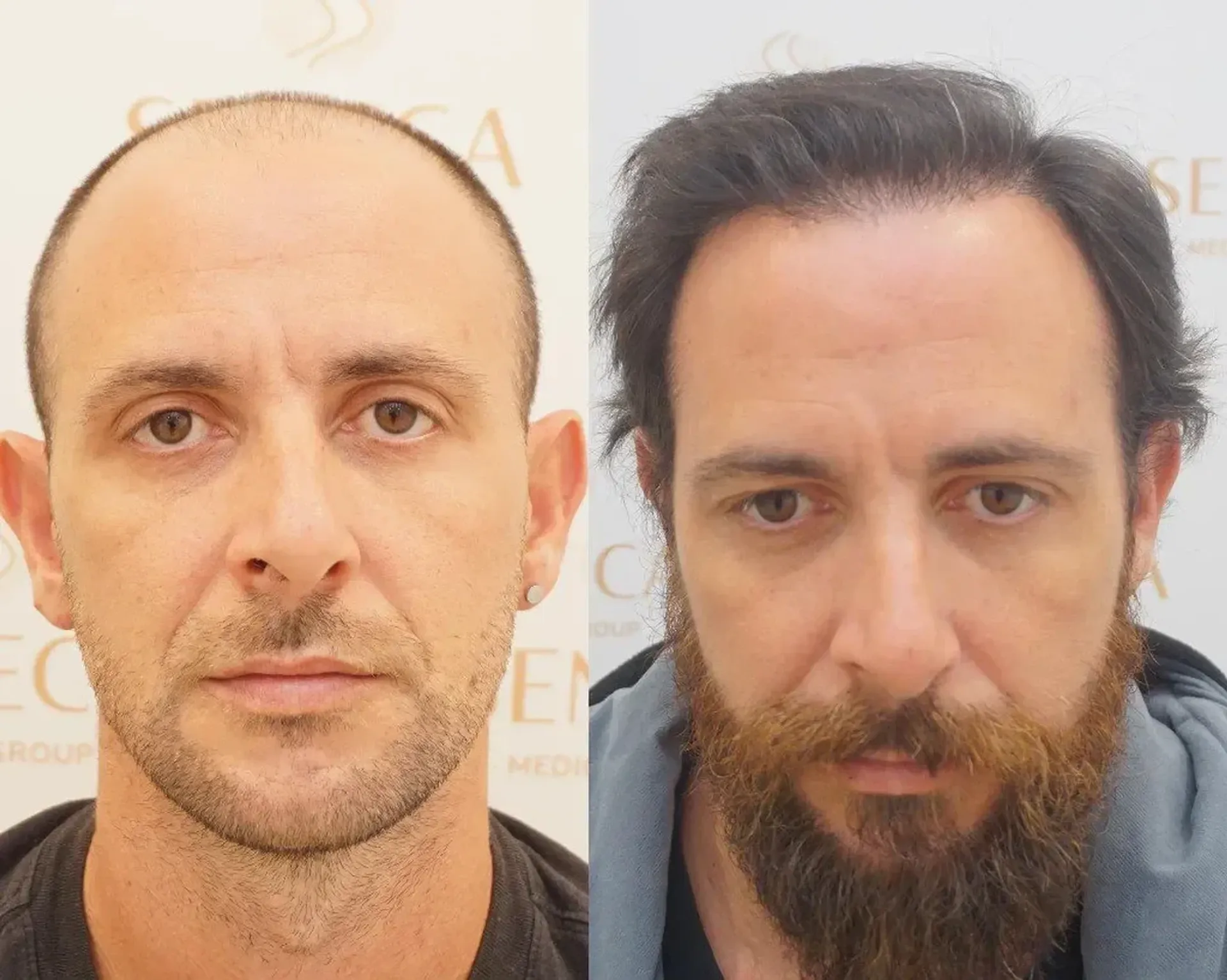 Before/After - Extensive Hair Loss & Frontal area - FUE motorized & Direct FUE (DHI) results