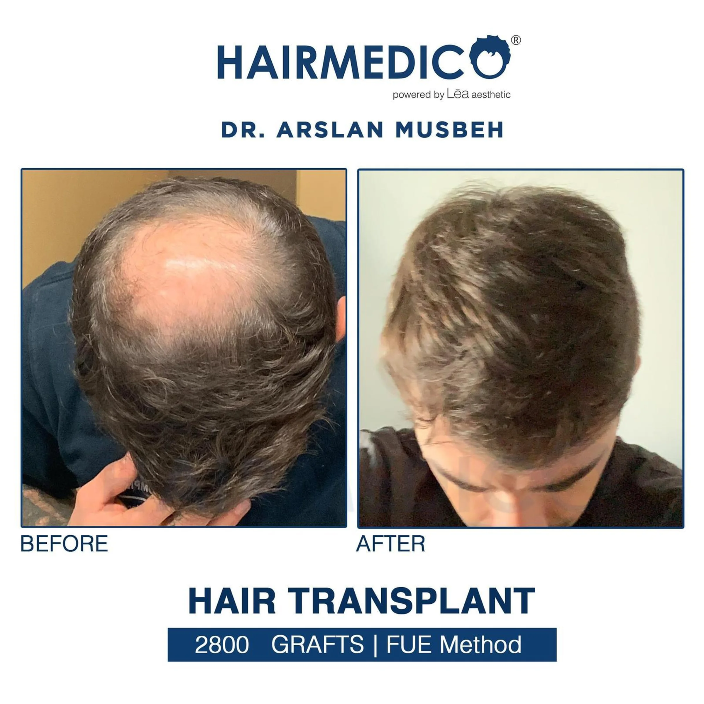 Dr Arslan, HAIRMEDICO, Estambul, Turquía - Photo 2