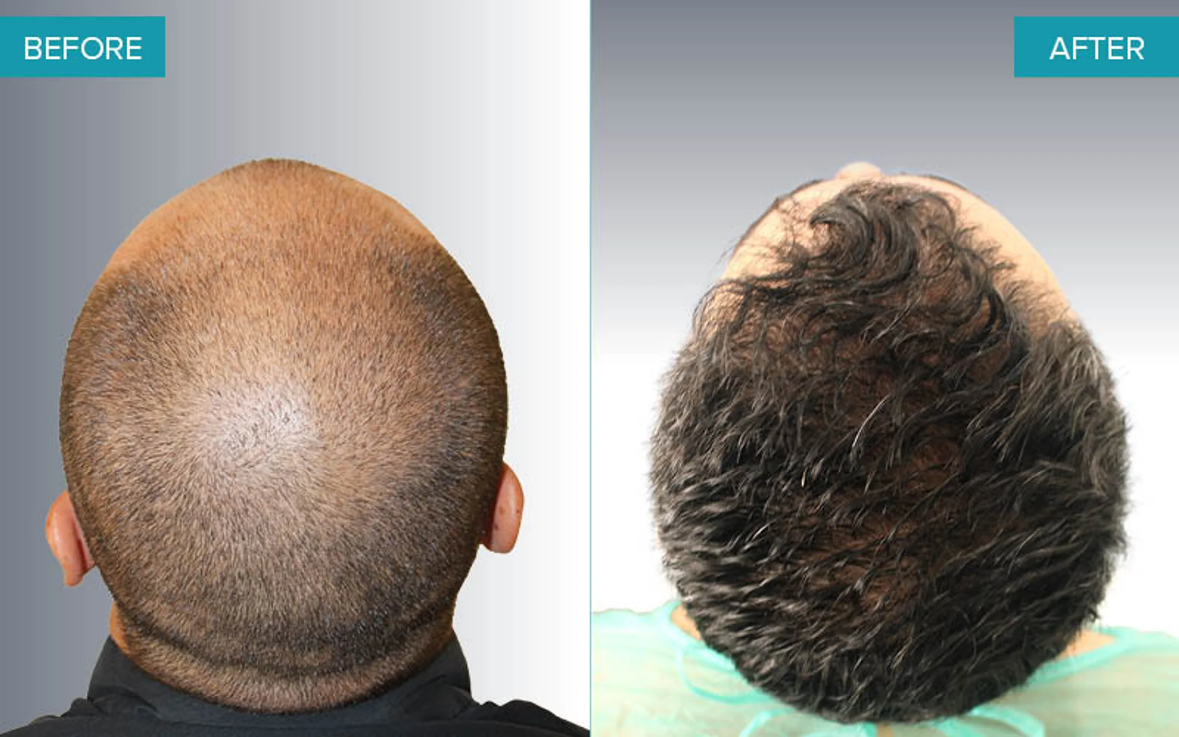 Advanced Hair Clinics, Athens, Greece - Photo 3