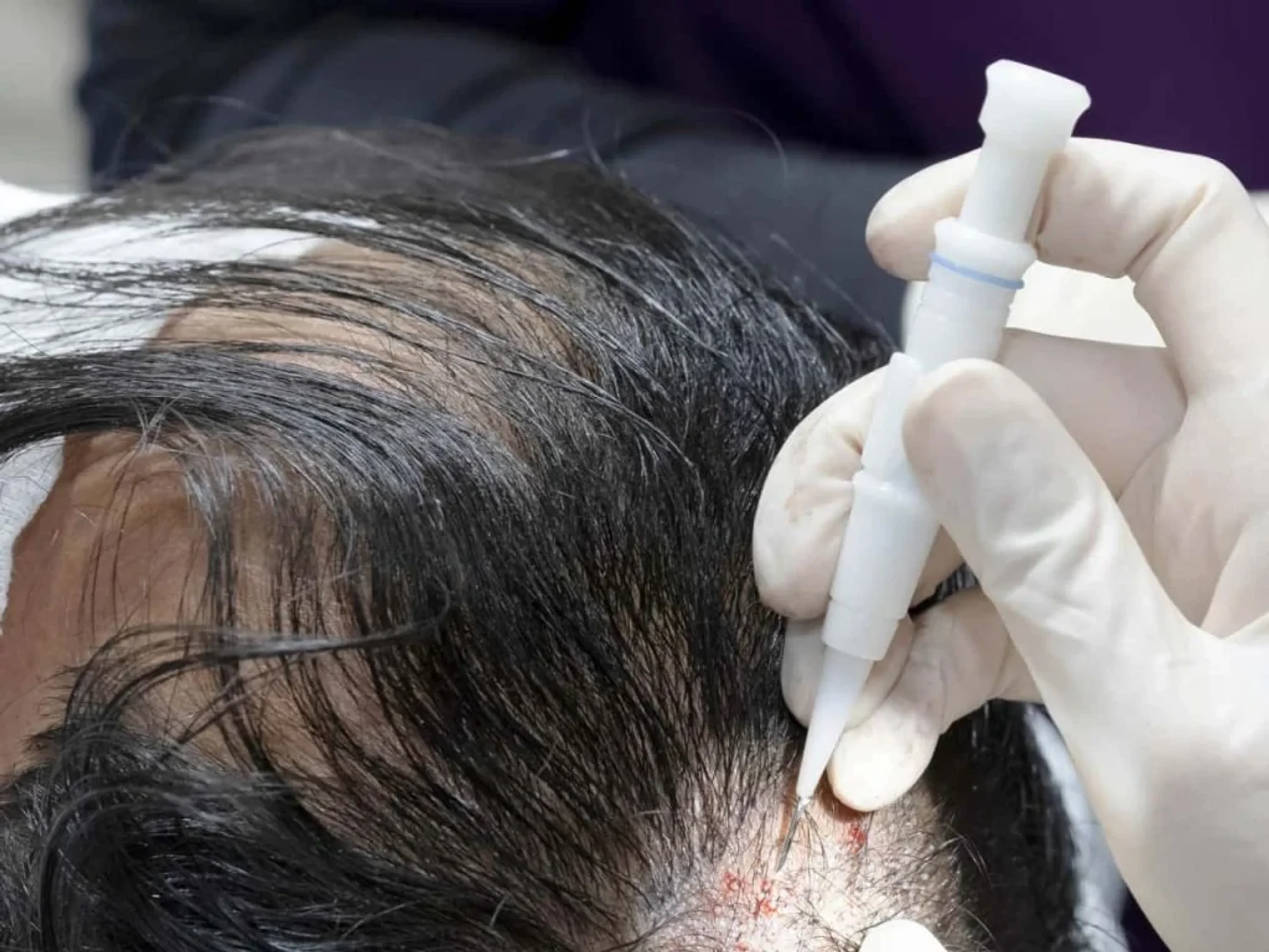 Advanced Hair Clinics, Athens, Greece - Photo 3