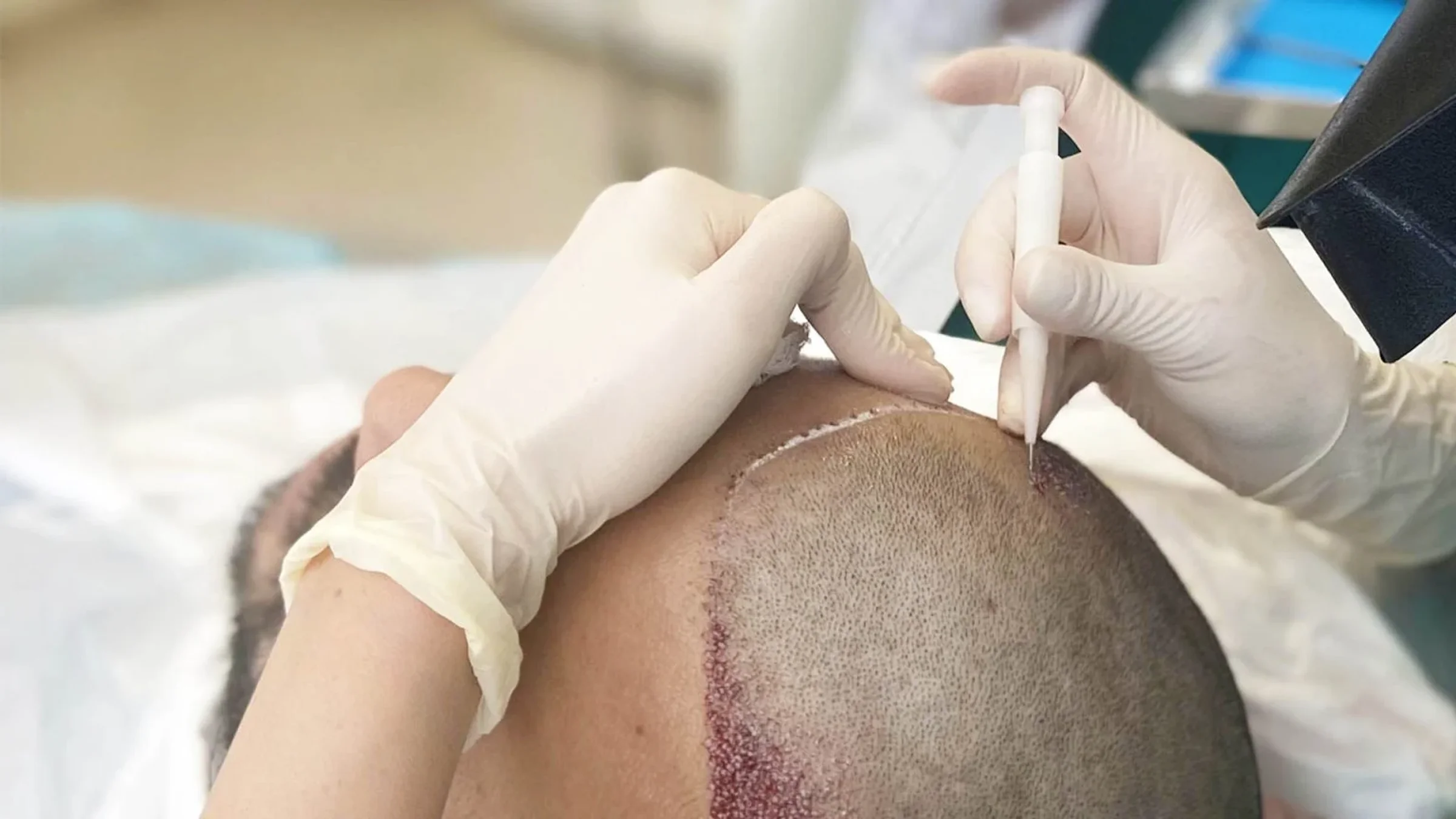 Advanced Hair Clinics, Athens, Greece - Photo 2